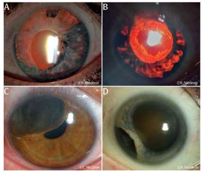 The iris in health and disease, part II: Iris transillumination defects and rubeosis iridis-fig-2.jpg