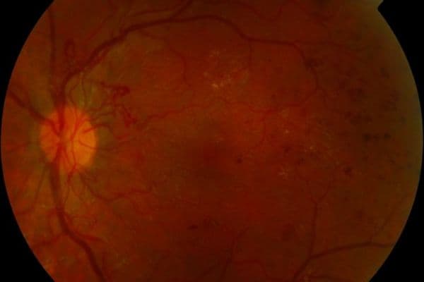 proliferative retinopathy online small