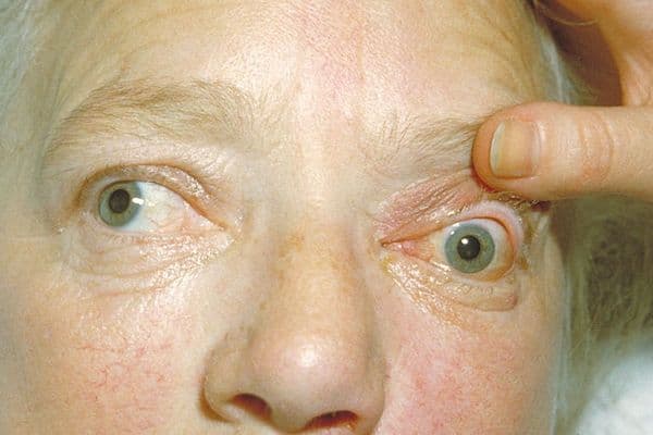 Teprotumumab promising for TED