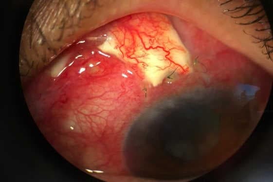 Managing glaucoma – a journey of faith and patience