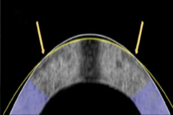Laser-free corneal reshaping