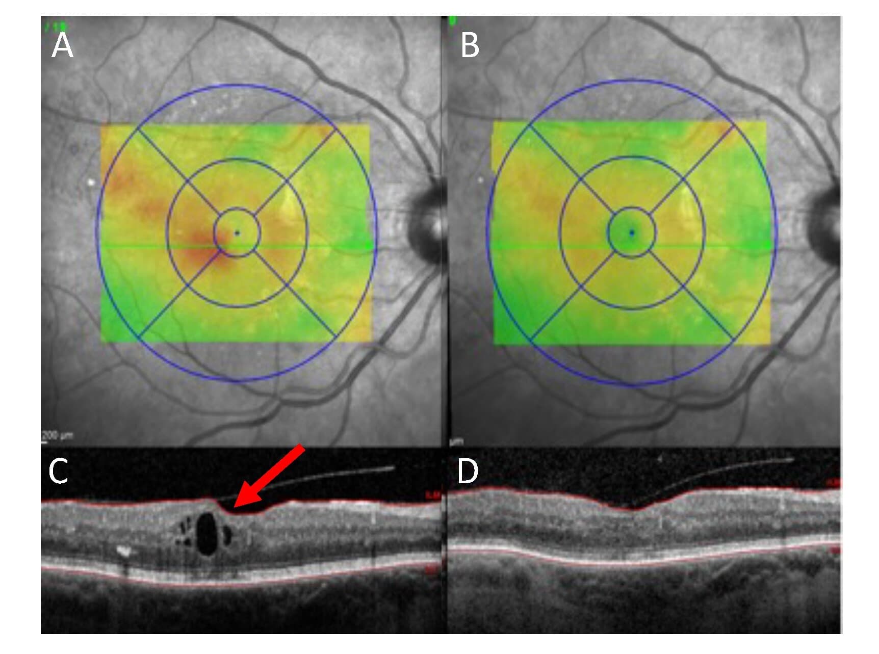 Macular oedema: new light on the horizon?-ssi-fig2.jpg