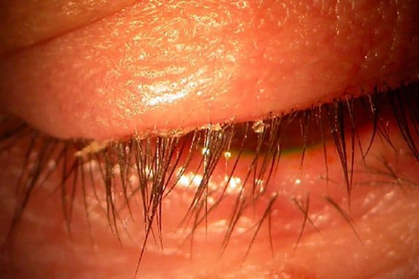 osl blepharitis