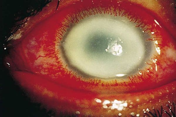 Outcome insights for Acanthamoeba keratitis?
