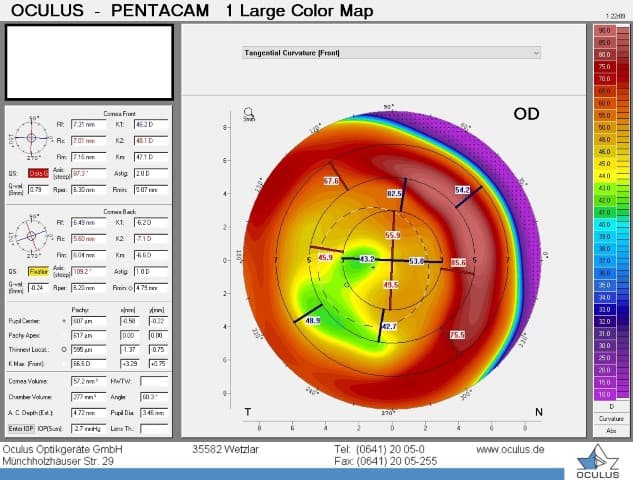 New post-surgery lens for irregular-cornea patients-fig-1-large-map.jpg