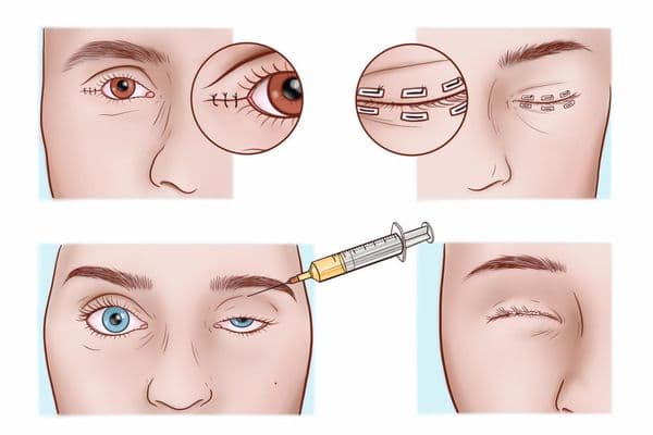 Adjusting eyelid position brings dry eye relief
