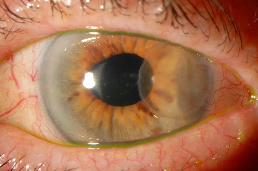 A rare case of Mycobacterium chelonae keratitis-mycobacterium-case-fig-5.jpg
