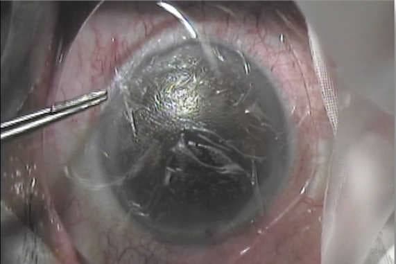 Research update: amniotic membrane for DED