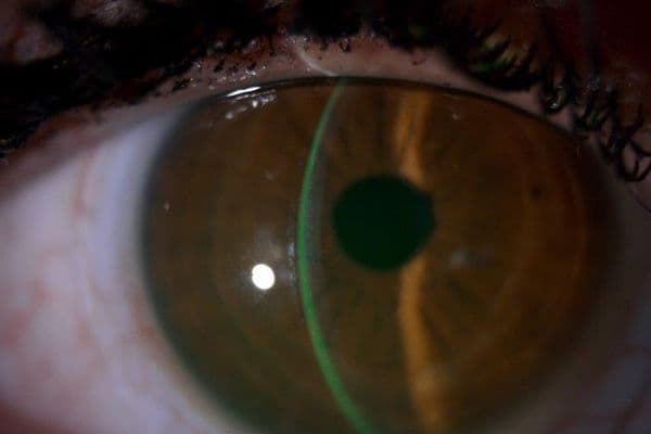 Scleral lenses in DED management