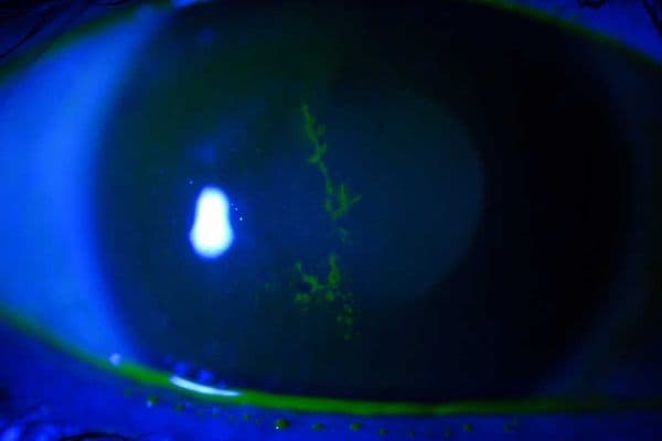 Update on herpes zoster ophthalmicus