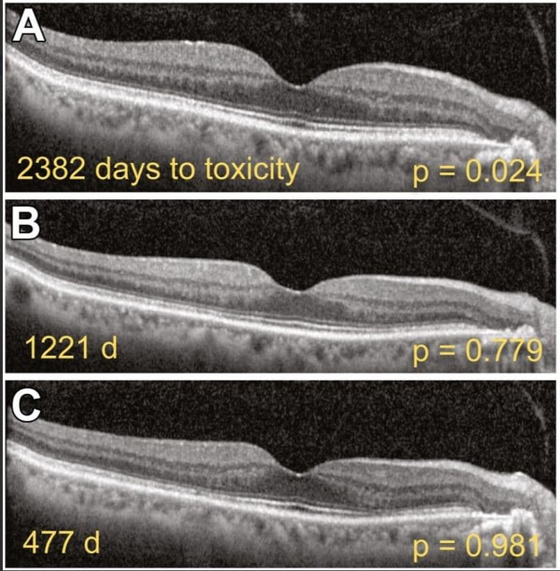 HCQ Retinopathy Shrunk