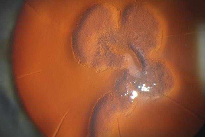 Spherophakia image wins slit lamp competition-03-kathleen-warren.jpg
