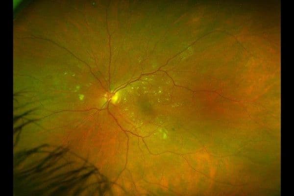 DMO: looking beyond HbA1c