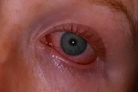 Conjunctivitis, a sign for Covid-19?