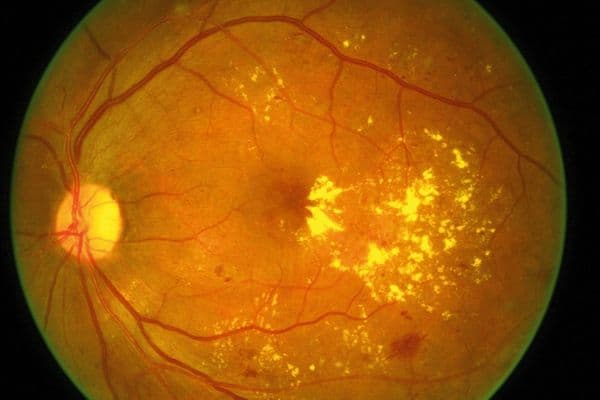 severe diabetic macular oedema