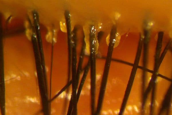 Antiparasitic efficacy of eyelid cleansers for Demodex blepharitis
