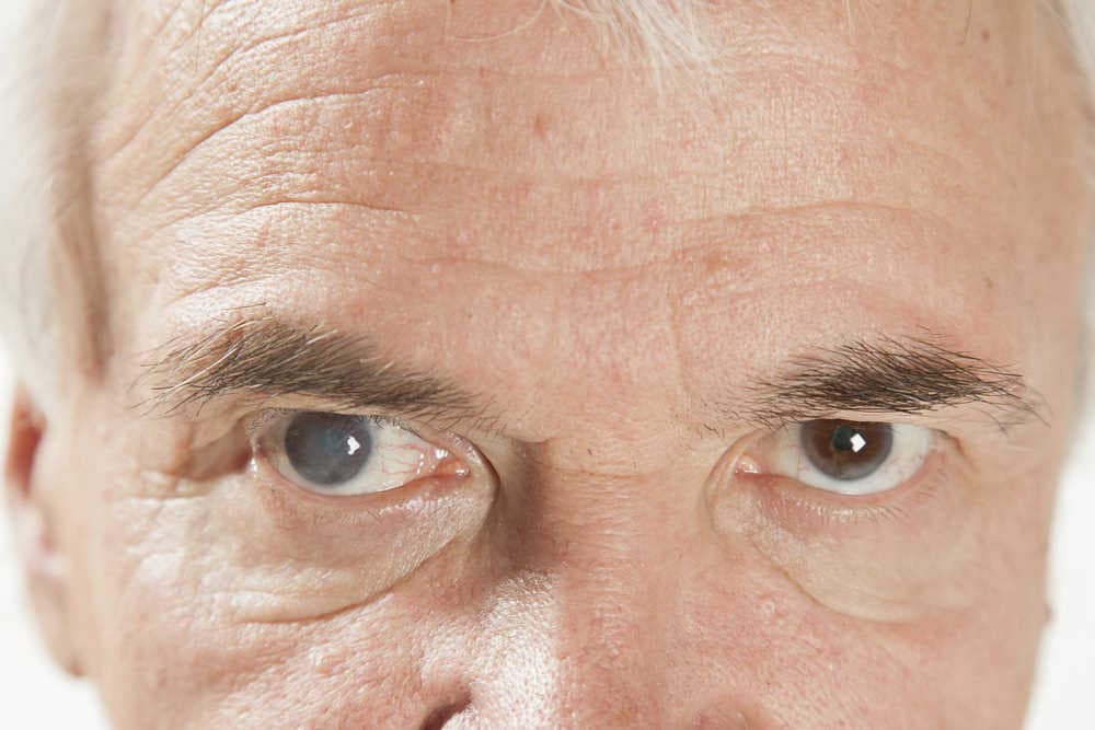 RANZCO shuns new Australian cataract standard-cataracts.jpg