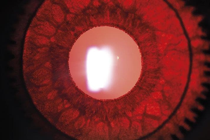 Spherophakia image wins slit lamp competition-02-rob-hancock.jpg