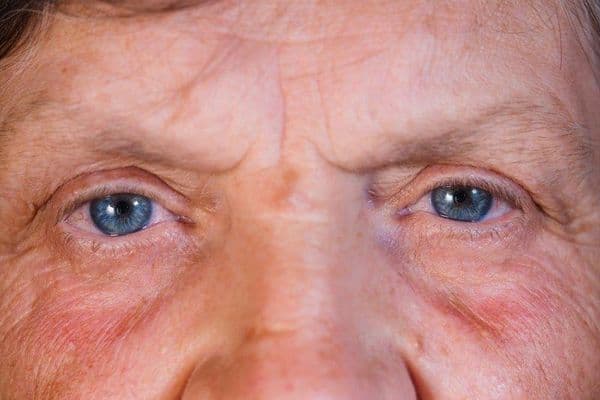 Improving SS screening accuracy among DED patients