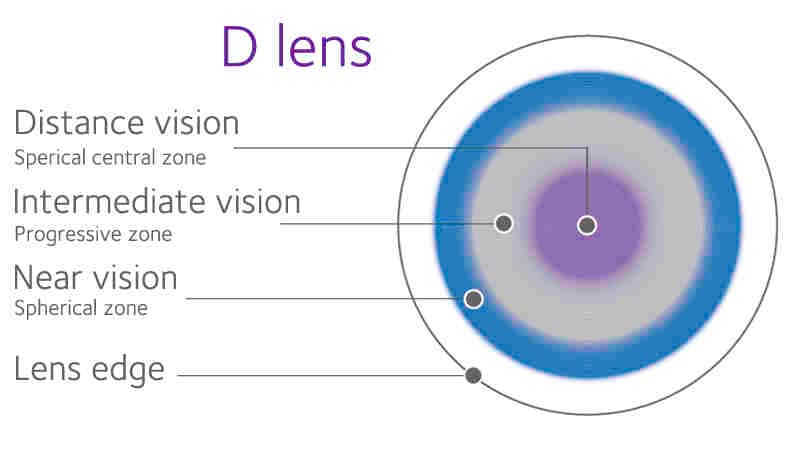 Non-ortho-k CL options for myopia control-fig-1.jpg