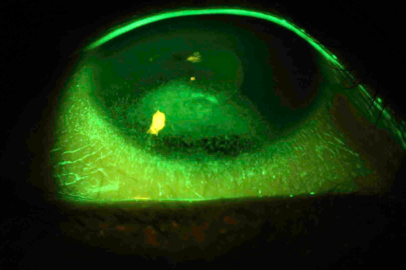 Bandage Contact Lenses-fig-4.jpg