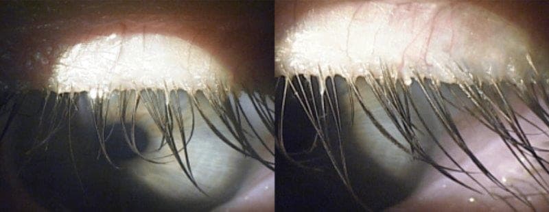 Demodex Collarettes By Tarsus