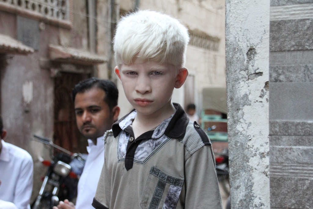 CLs in albinism – BLENNZ’s akonga experience