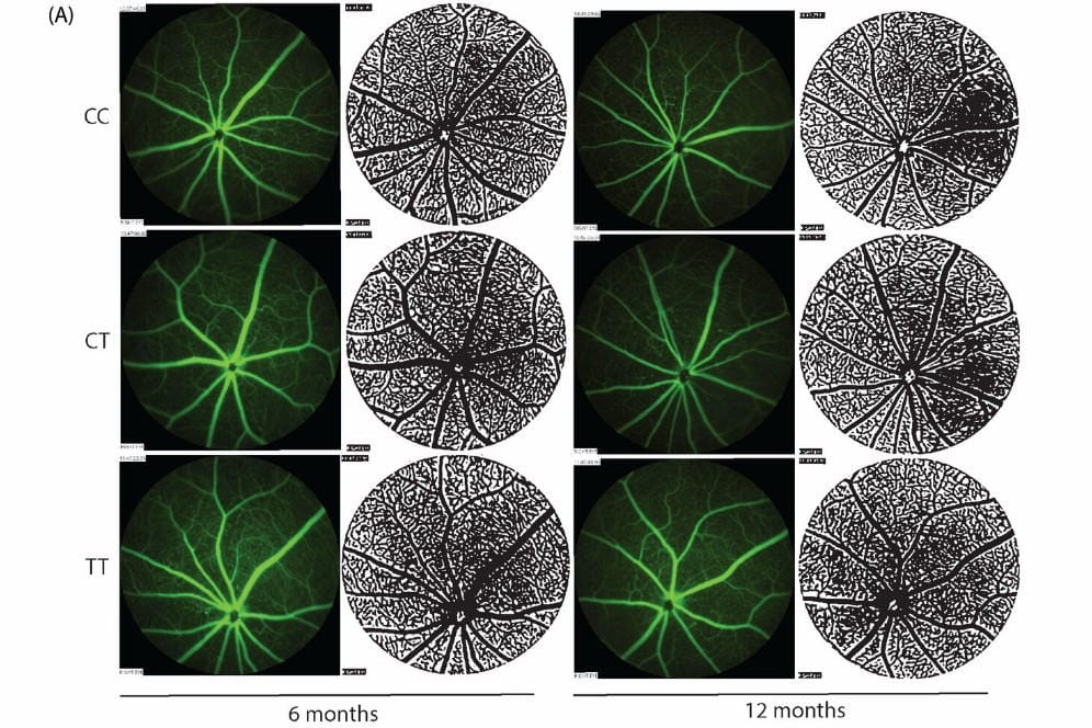 Retinal imaging biomarker for Alzheimers