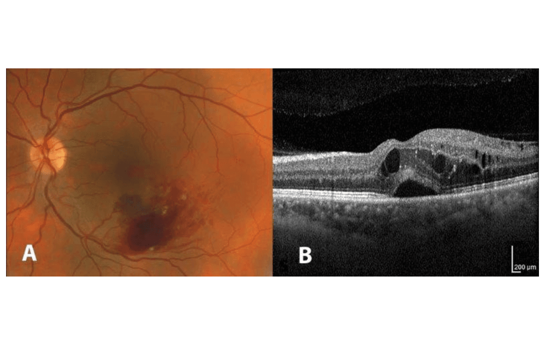 Macular oedema: new light on the horizon?