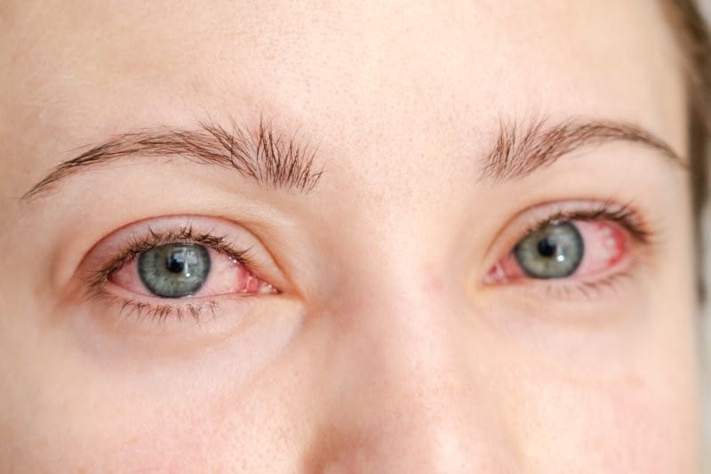 close up red irritated human eyes