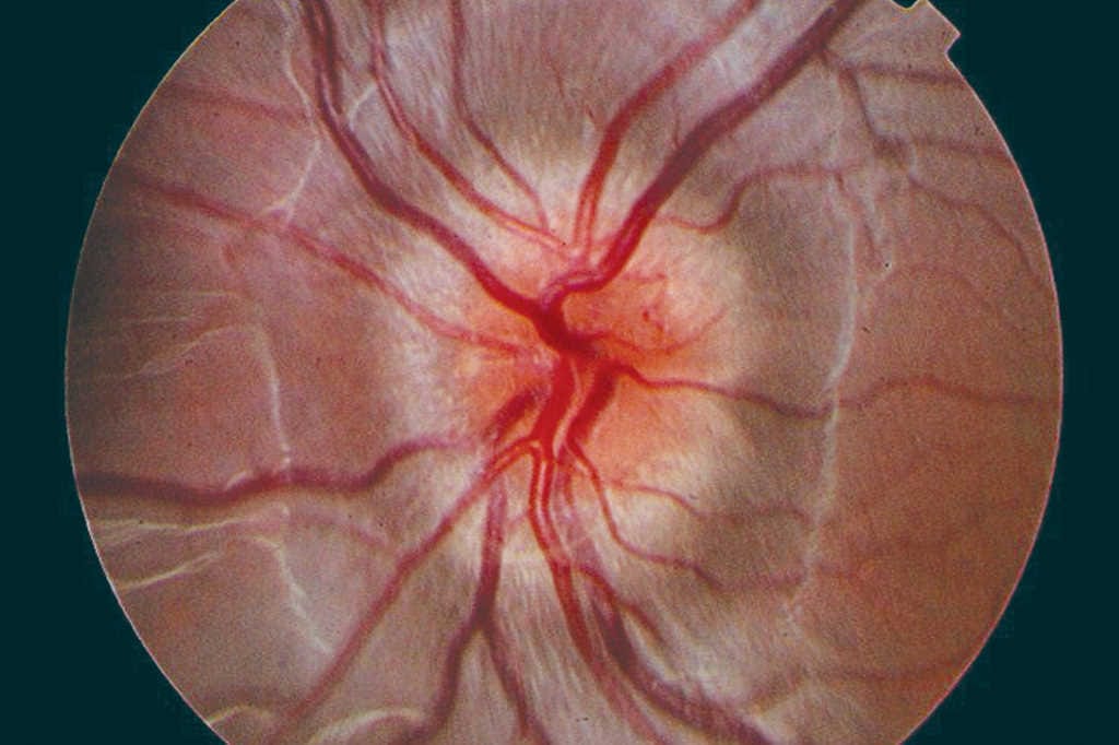 Brain tumours warrant eye checks