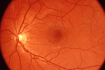 Google screening for anaemia