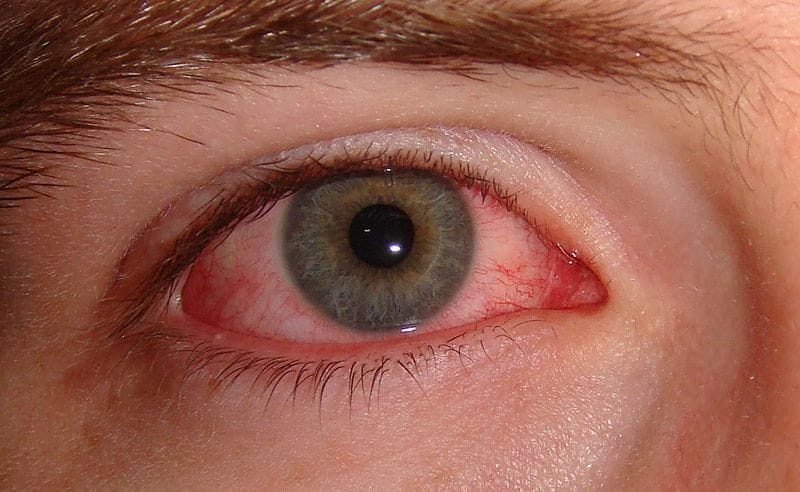 red and dry eye close up