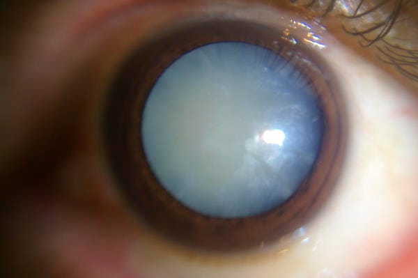 Post-op cataract checks could go