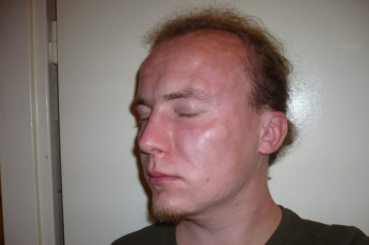 angioedema