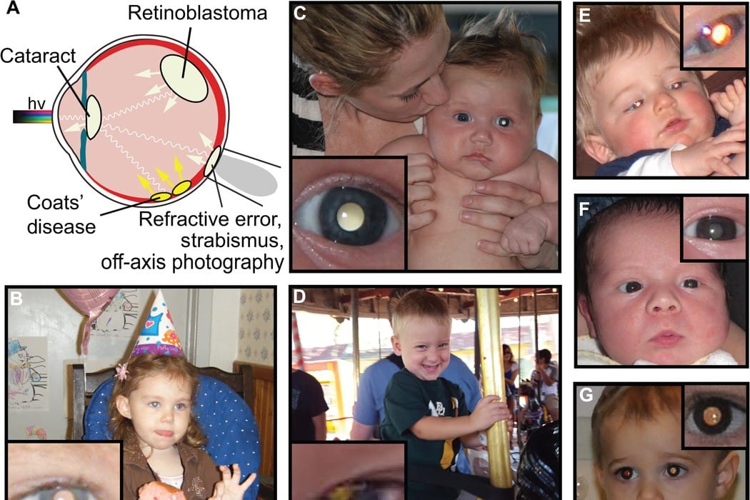 App detects eye disease from photos