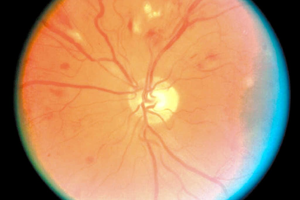 Hope for first DMI treatment
