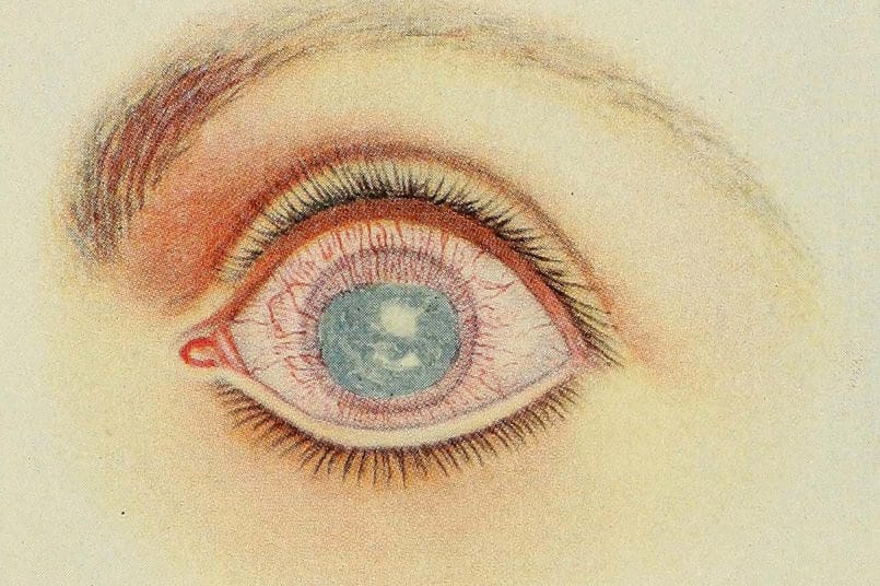 Ocular syphilis on the rise