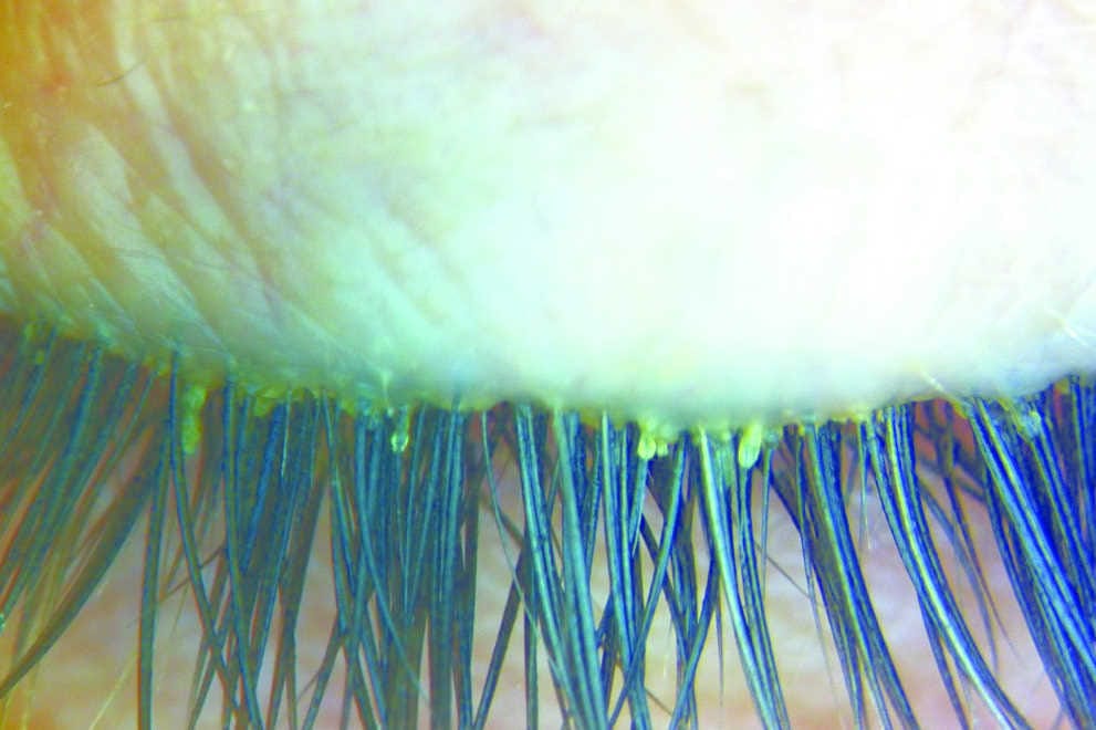 Demodex treatment advances