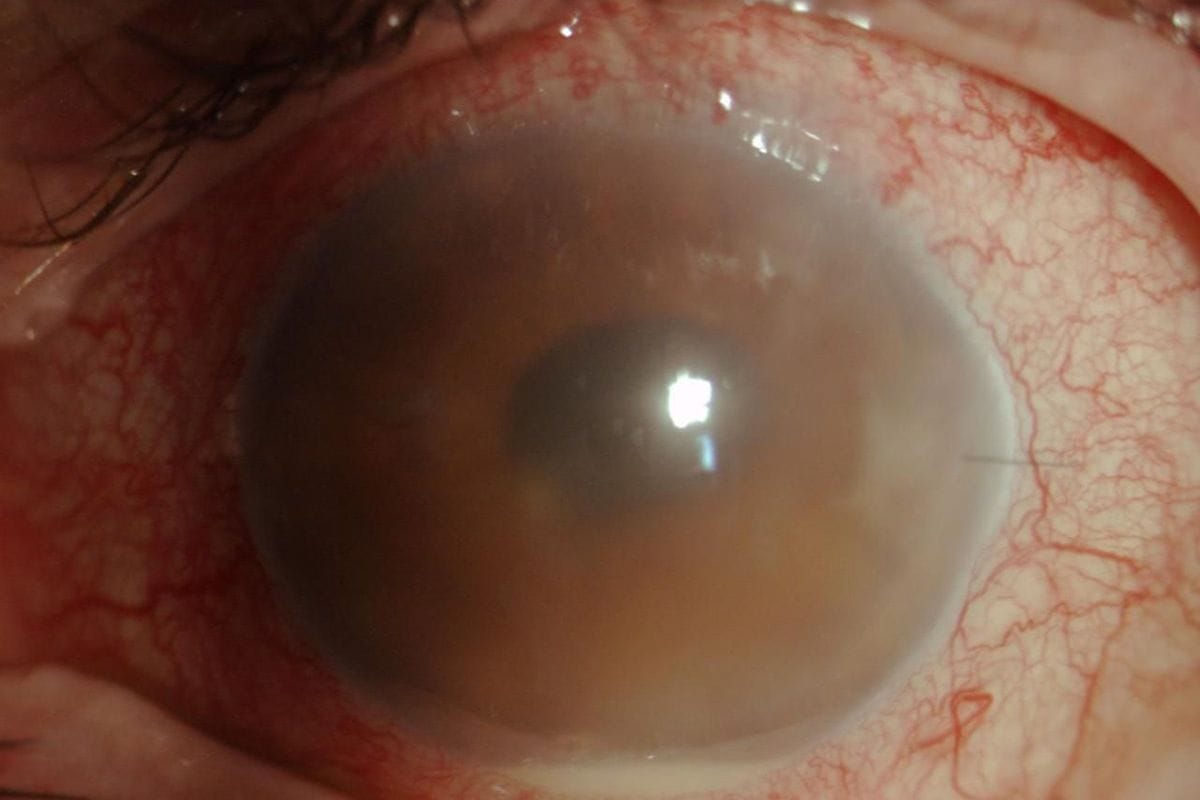 endophthalmitis ONLINE