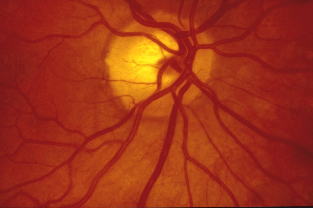 Fundus photography Normal human retina