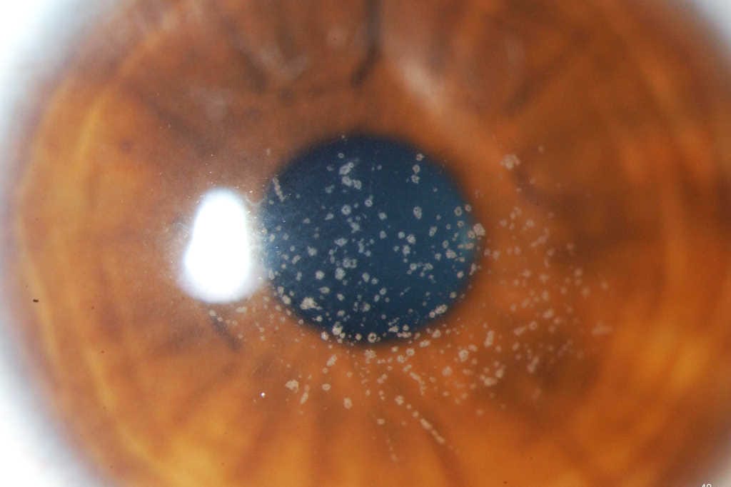 Getting granular on granular dystrophies
