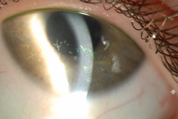 Herpes zoster ophthalmicus