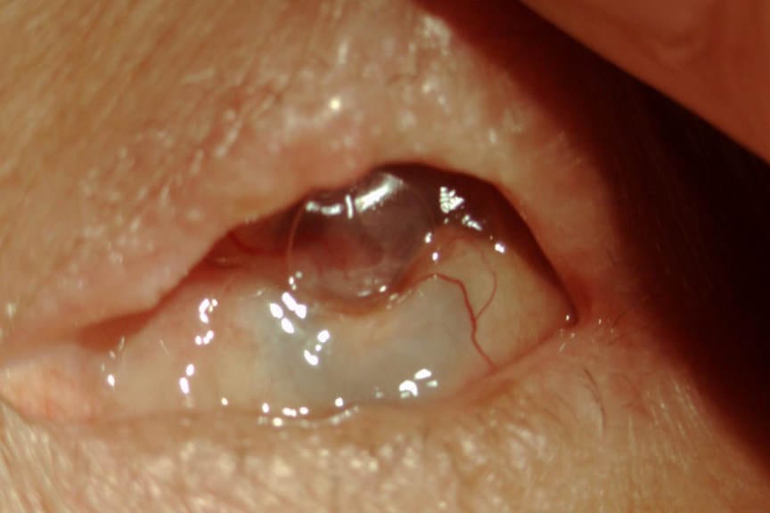Post-cataract endophthalmitis