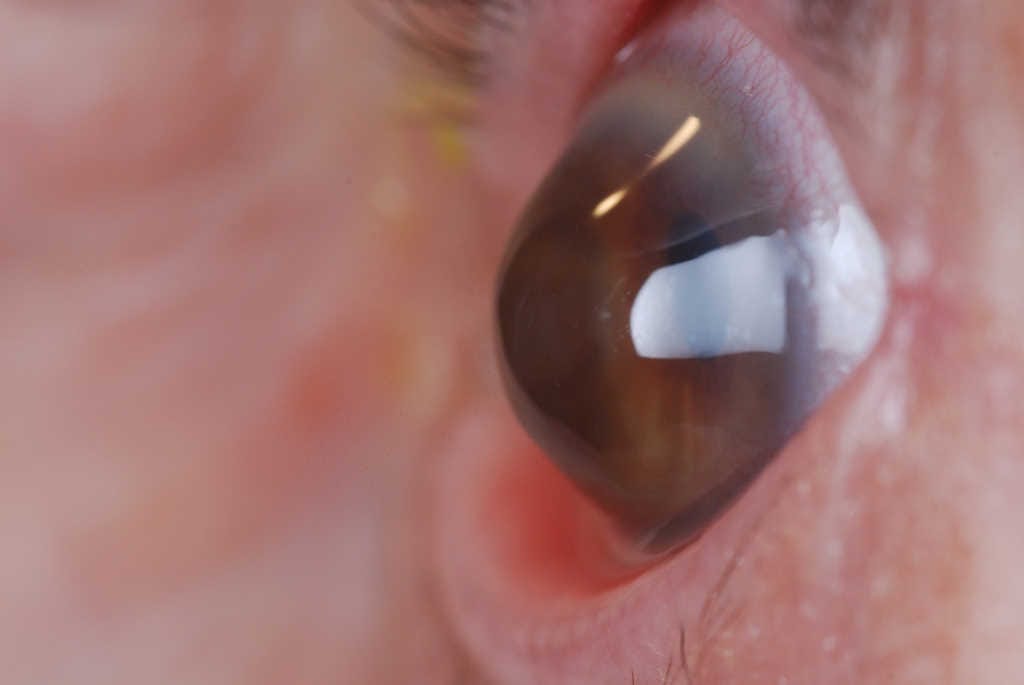 Mitomycin C after crosslinking increases corneal haze