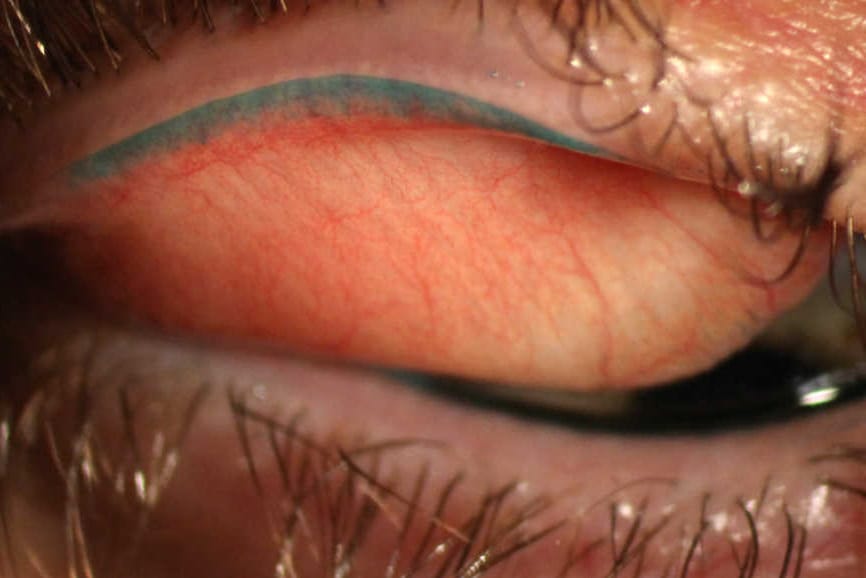 OSL: LWE trumps corneal staining for DED