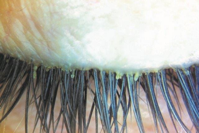 Calling ECPs: survey on Demodex blepharitis