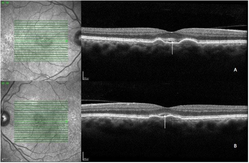 CASE STUDY: non-neovascular subretinal fluid in AMD (1)