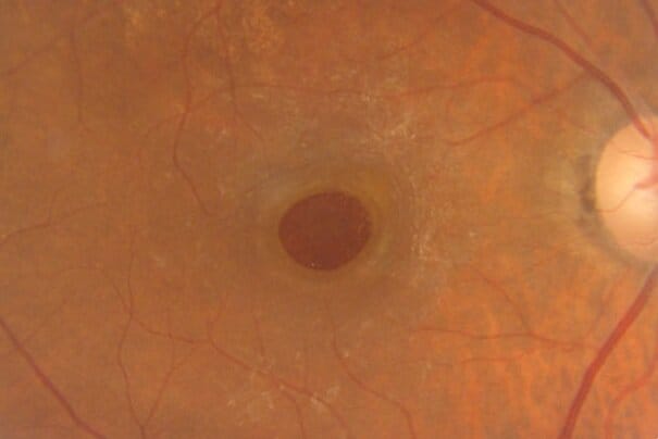 macular hole