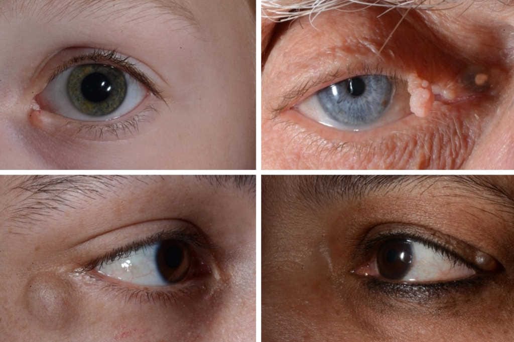 Keeping an eye out for periocular malignancy